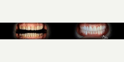Dental Crown before and after photo
