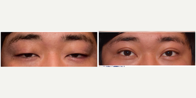 Double Eyelid Surgery before and after photo