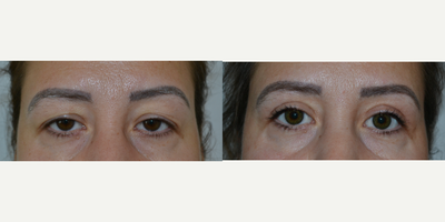 Eyelid Surgery before and after photo