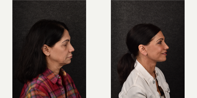 Eyelid Surgery before and after photo