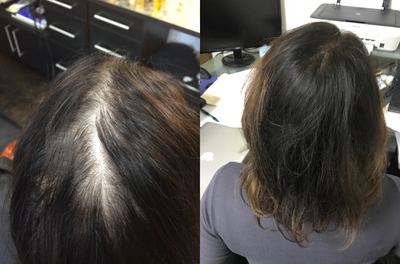PRP for Hair Loss before and after photo