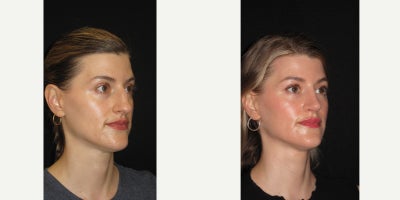 Rhinoplasty before and after photo