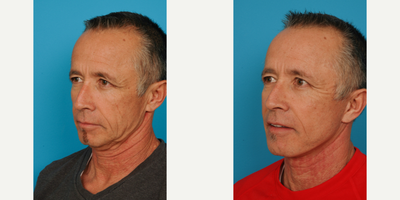 Facelift before and after photo