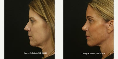 Facelift before and after photo