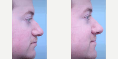Septoplasty before and after photo