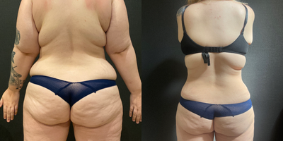 Diastasis Recti Repair before and after photo