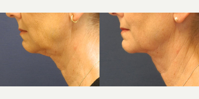Neck Lift before and after photo