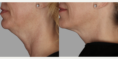 Buccal Fat Removal before and after photo