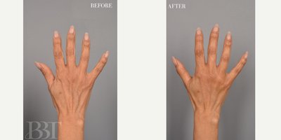 Dermal Fillers before and after photo