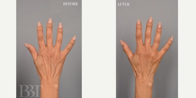 Dermal Fillers before and after photo