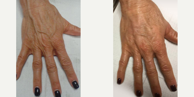 Hand Rejuvenation before and after photo