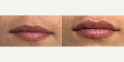 Juvederm before and after photo