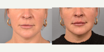 Lip Fillers before and after photo