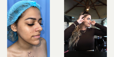 Rhinoplasty before and after photo