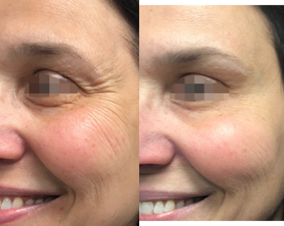 Botox before and after photo