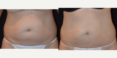 CoolSculpting before and after photo