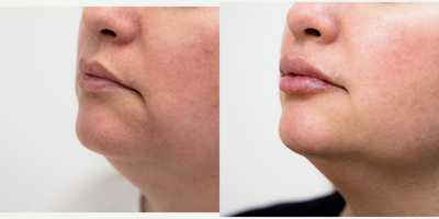 Dermal Fillers before and after photo