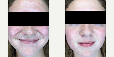 HydraFacial before and after photo