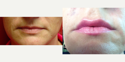 Juvederm before and after photo