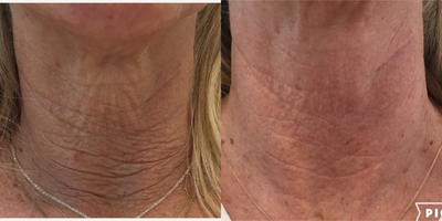 Skin Rejuvenation before and after photo