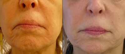 Vampire Facelift before and after photo