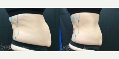 Vanquish before and after photo