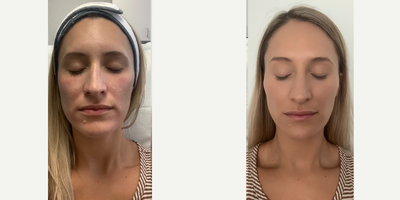 Voluma before and after photo