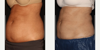 CoolSculpting before and after photo