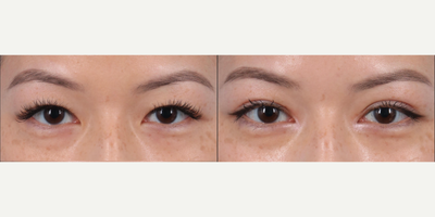 Double Eyelid Surgery before and after photo