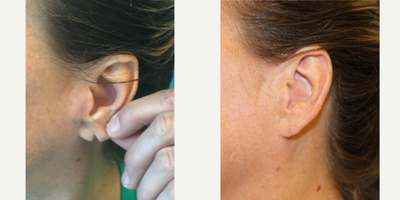 Earlobe Repair before and after photo