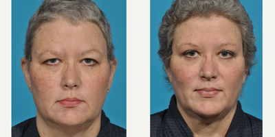 Eyelid Surgery before and after photo