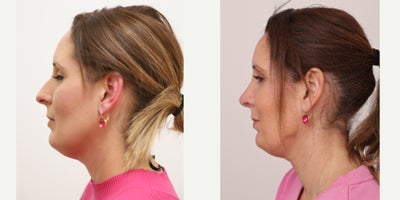 Rhinoplasty before and after photo