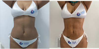Smart Lipo before and after photo
