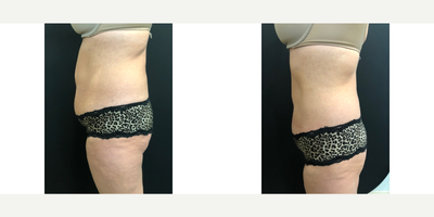 Emsculpt before and after photo