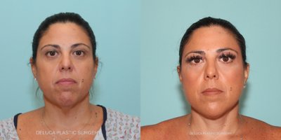 Lower Facelift before and after photo