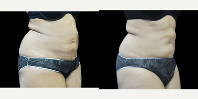 SculpSure before and after photo