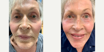 Skin Rejuvenation before and after photo