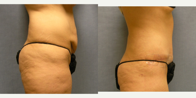 Tummy Tuck before and after photo