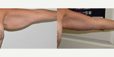 Arm Lift before and after photo