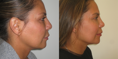 Asian Rhinoplasty before and after photo