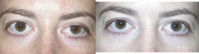 Eyelid Surgery before and after photo