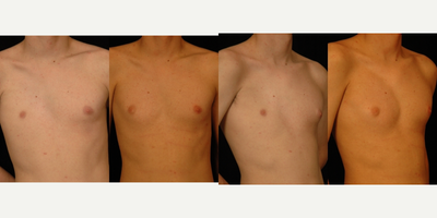 Pec Implants before and after photo
