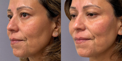 Cheek Fillers before and after photo