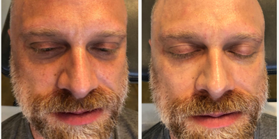Dermal Fillers before and after photo
