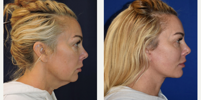 Facelift before and after photo