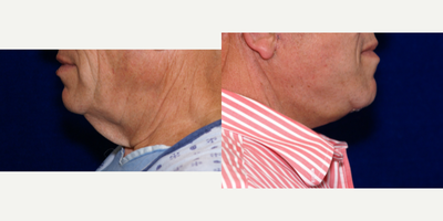 Facelift before and after photo
