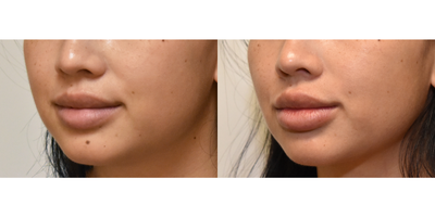 Mole Removal before and after photo