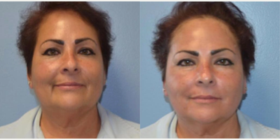 PRP Injections before and after photo