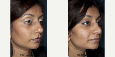 Rhinoplasty before and after photo
