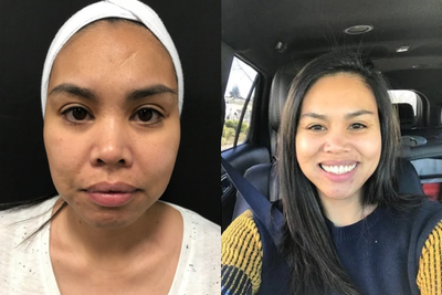 Vampire Facelift before and after photo